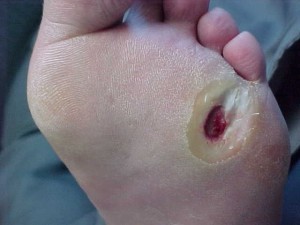 diabetic ulcers