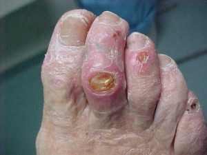 diabetic ulcers