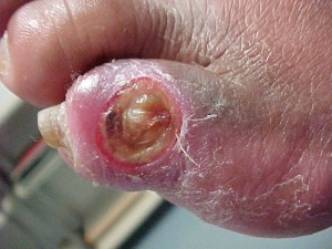 diabetic ulcers