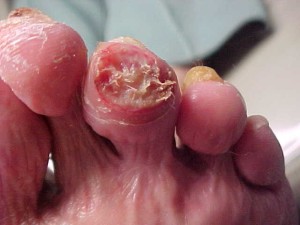 diabetic ulcers