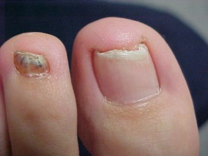 toenail fungus