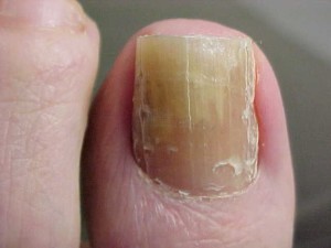 toenail fungus