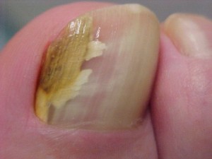 toenail fungus