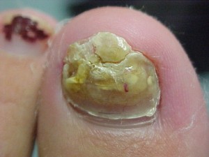 toenail fungus