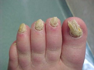 toenail fungus