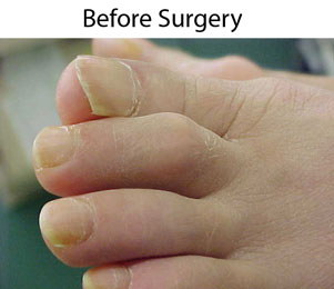 hammertoe