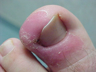 ingrown toenail