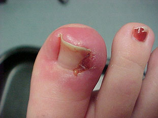 ingrown toenail