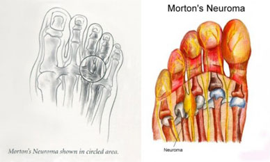 neuromas